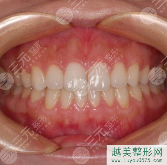 上海九院口腔科牙齿矫正前后对比图