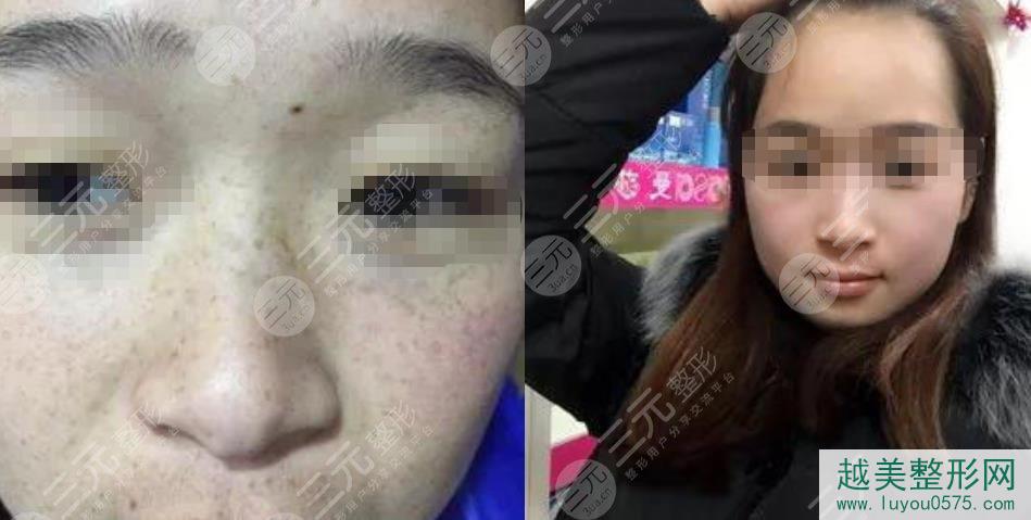 杭州市三医院美容科祛斑案例