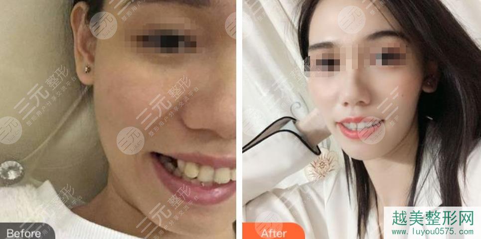 杭州口腔医院牙齿矫正案例