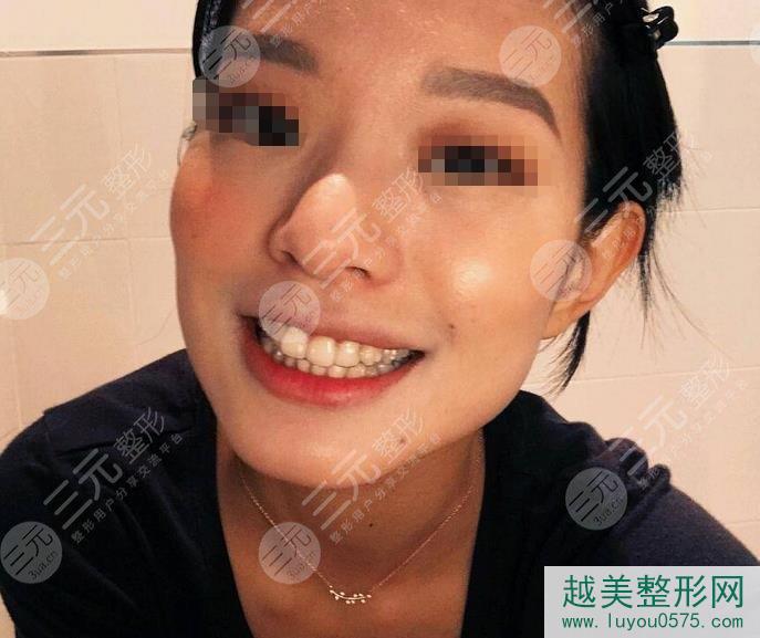 杭州口腔医院牙齿修复案例