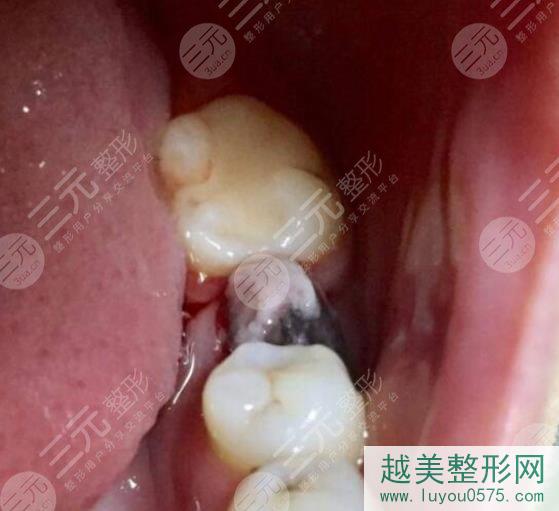 杭州口腔医院种植牙案例