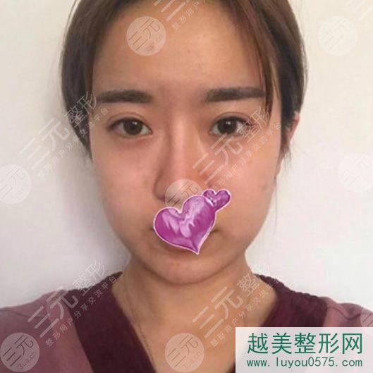 上海第九人民医院整形美容面部填充案例