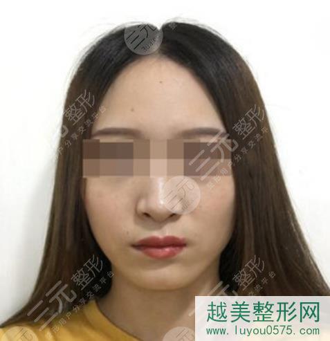 上海九院美容科注射瘦脸案例