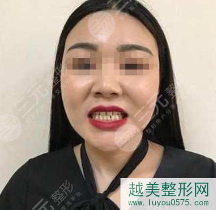 北京维尔口腔医院种植牙反馈图