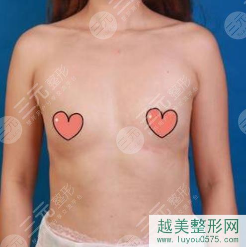上海九院整形科专家自体脂肪隆胸果图