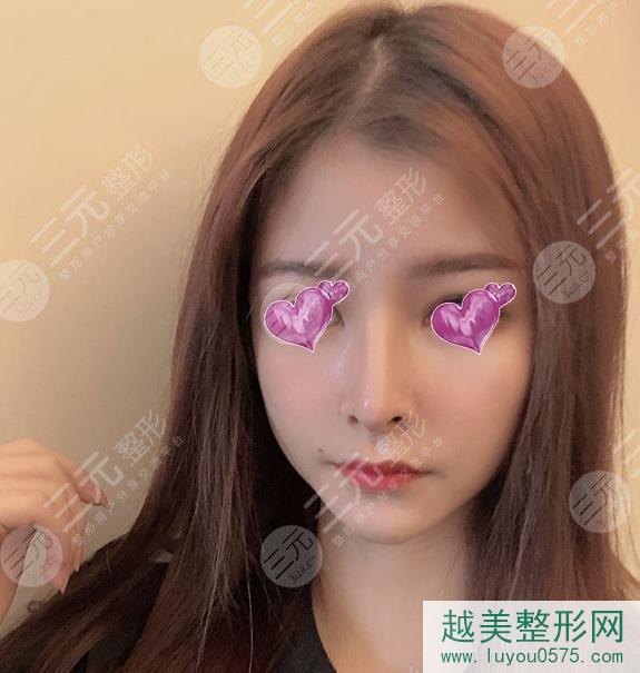 上海九院李青峰做鼻子手术恢复