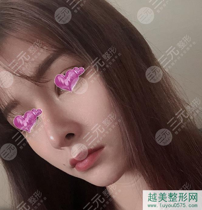 上海九院李青峰做鼻子手术恢复