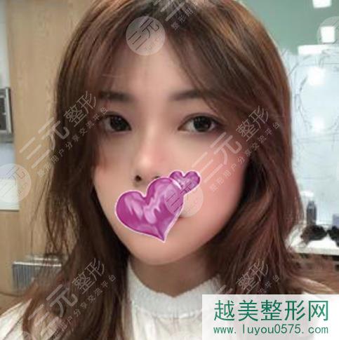 上海第九人民医院整形隆鼻案例