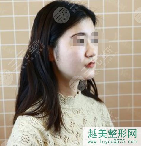 上海二院整形科隆鼻案例
