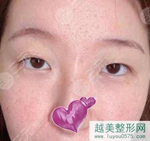 上海九院整外张余光双眼皮修复案例