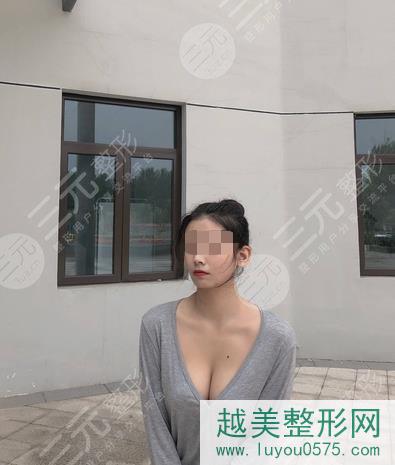 武汉第三医院整形科林亮隆胸案例