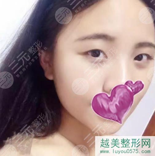 杭州117医院整形科割双眼皮案例