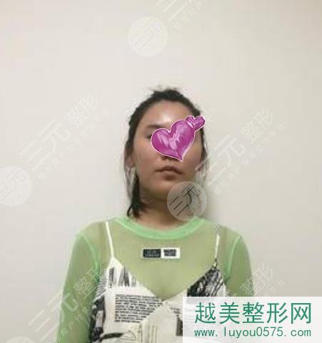 北京八大处假体隆胸案例