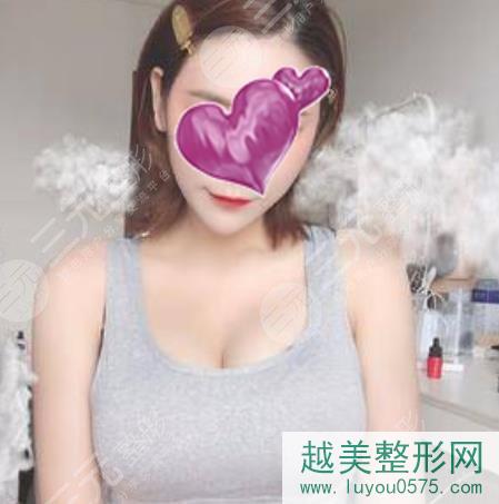 北京八大处假体隆胸案例