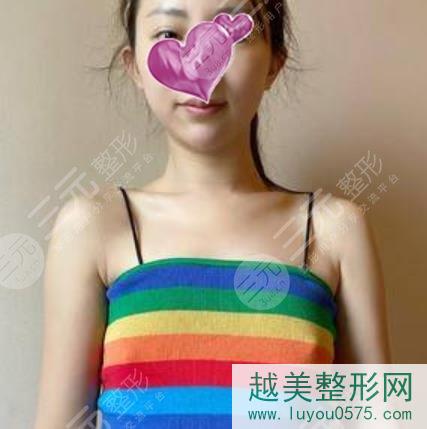 上海美丽江南整形隆胸案例