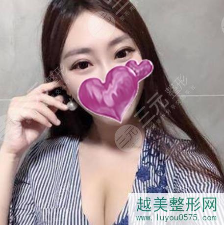 上海美丽江南整形隆胸案例