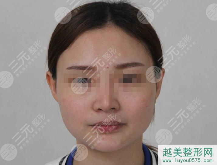 上海韩镜整形医院下颌角切除案例