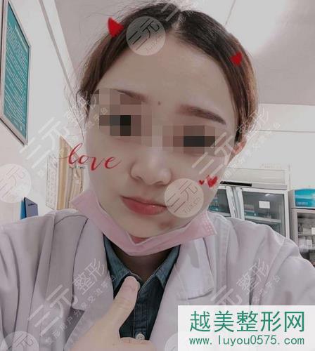 上海韩镜整形医院下颌角切除案例