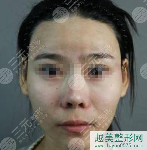 北京八大处下颌角磨骨案例