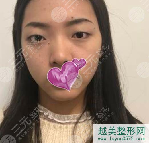 北京朝阳医院整形外科去眼袋案例