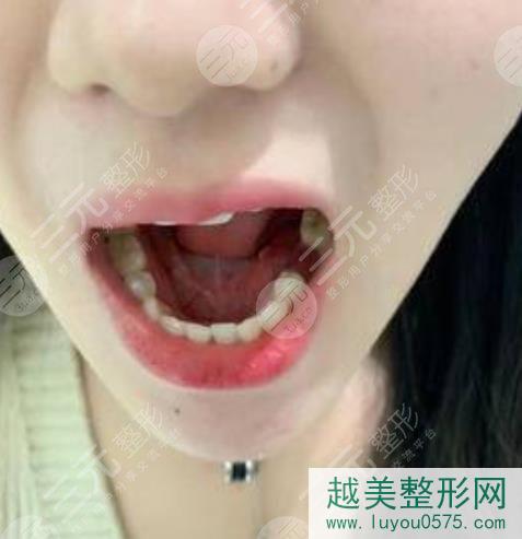 北京维尔口腔医院种植牙案例