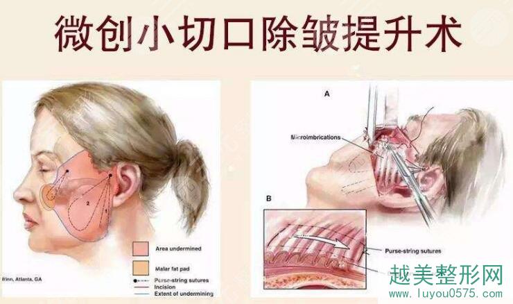 上海九院拉皮手术方法