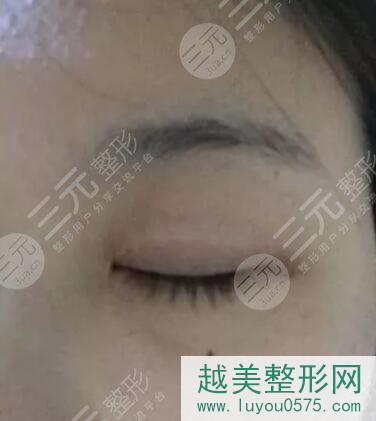 湘雅祁敏双眼皮手术案例
