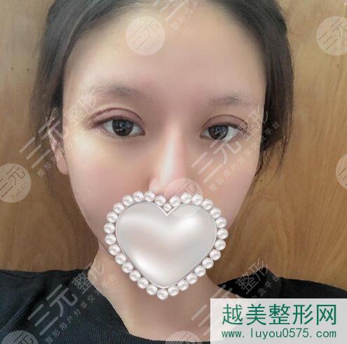 北京301整容医院双眼皮案例