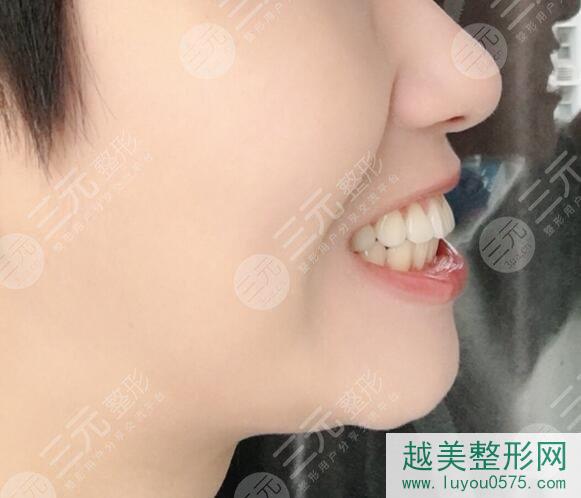 长沙市口腔医院牙齿正畸案例前