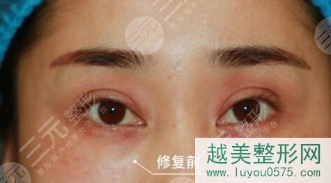 上海9院整形科双眼皮修复案例前