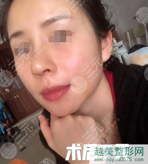 上海九院整形科鼻头缩小案例后7天