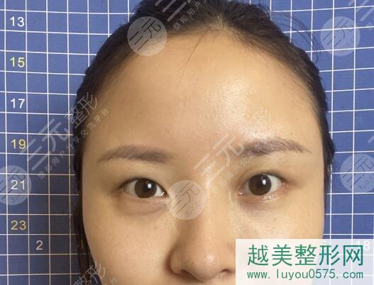 上海安缦医疗美容整形双眼皮案例前