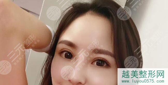 上海安缦医疗美容整形双眼皮案例后