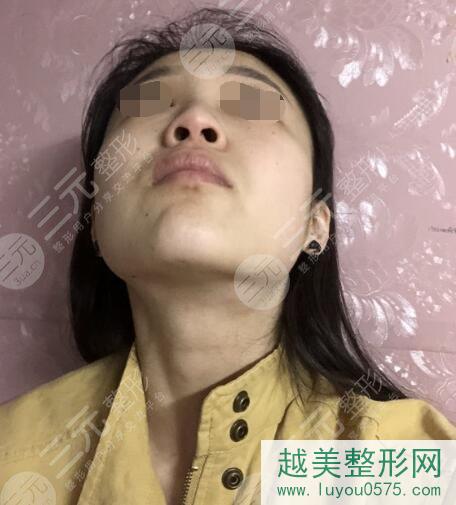 上海第九整形美容医院隆鼻案例前