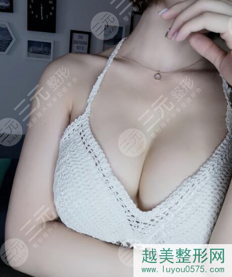 上海九院整形隆胸案例后
