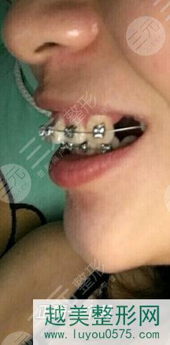 好牙依口腔连锁正畸案例一个月