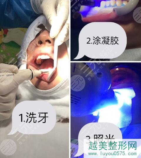 深圳人民医院口腔科牙齿美白案例过程