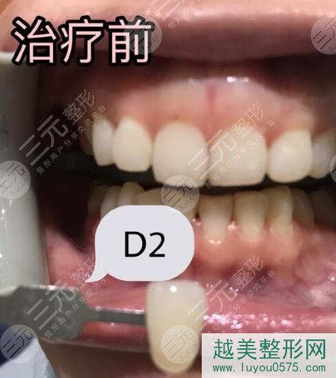 深圳人民医院口腔科牙齿美白案例前
