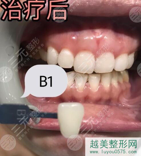 深圳人民医院口腔科牙齿美白案例后