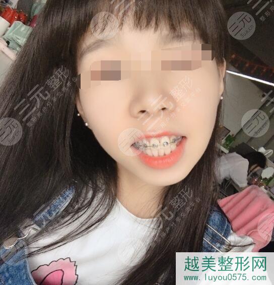 北京维尔口腔医院牙齿矫正案例后