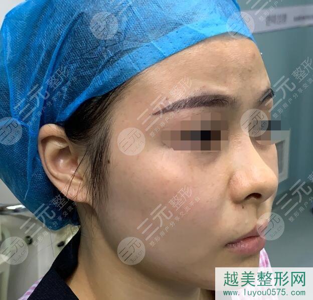 广州中科美医疗美容医院隆鼻手术前