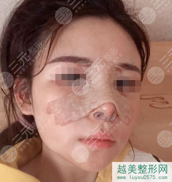 广州中科美医疗美容医院隆鼻手术后一周