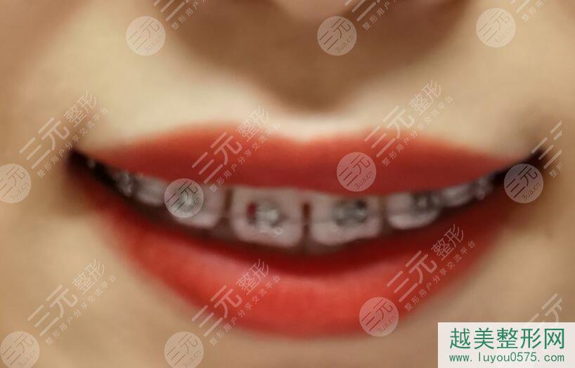 北京维尔口腔医院牙齿矫正前