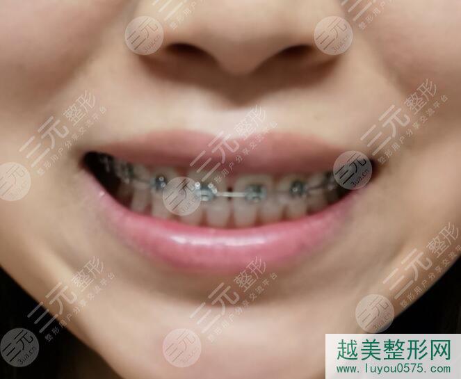 北京维尔口腔医院牙齿矫正后