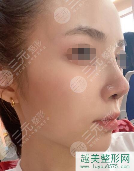 北京八大处整容鼻部手术后一周