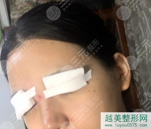 西京医院整形双眼皮案例后一周