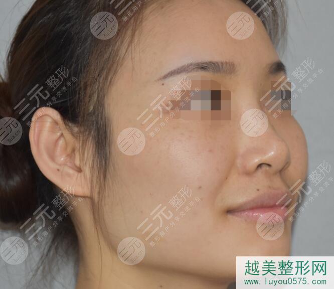 北京巫文云鼻部手术案例