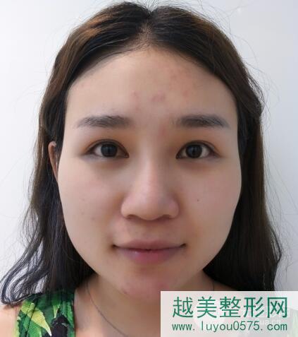 北京清木医疗美容怎样？附面部吸脂全过程及术后对比照片