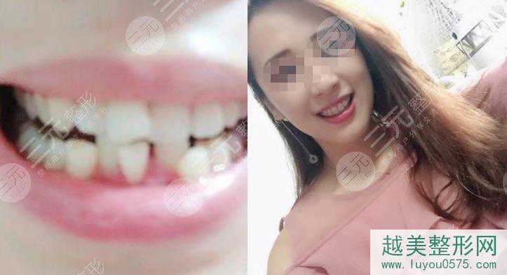衢州市口腔医院牙齿矫正案例