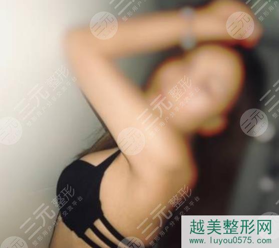 杭州树兰医院整形科自体脂肪丰胸案例
